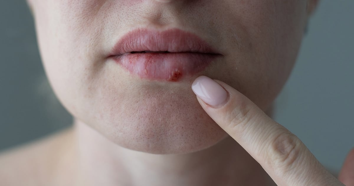 Un paso clave contra el herpes que no responde: la FDA aprobó un antiviral oral inédito en casi 30 años
